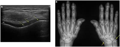 Recent advances in the therapeutic management of calcium pyrophosphate deposition disease